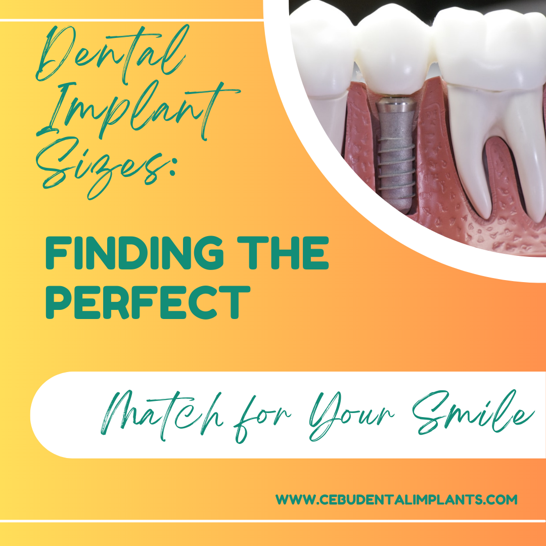 Dental Implant Sizes Finding the Perfect Match for Your Smile Cebu